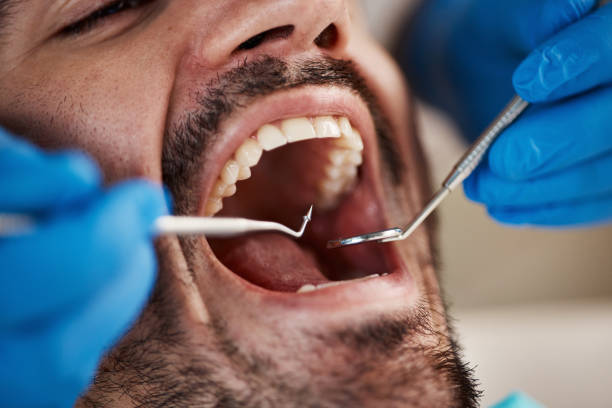 Best Knocked-Out Tooth (Avulsed Tooth) Treatment in Gaffney, SC